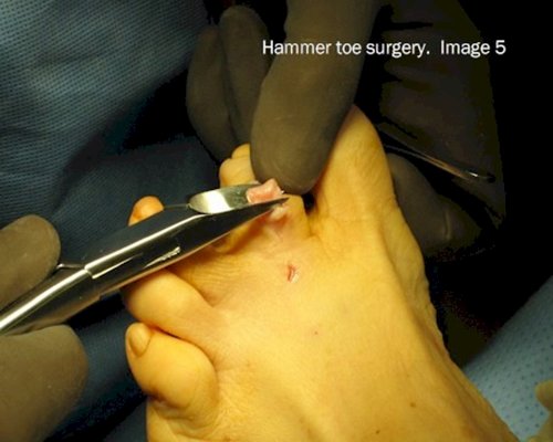 What is the treatment for hammertoe?